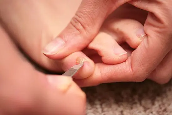 Comment se débarrasser des ongles de pied jaune ?